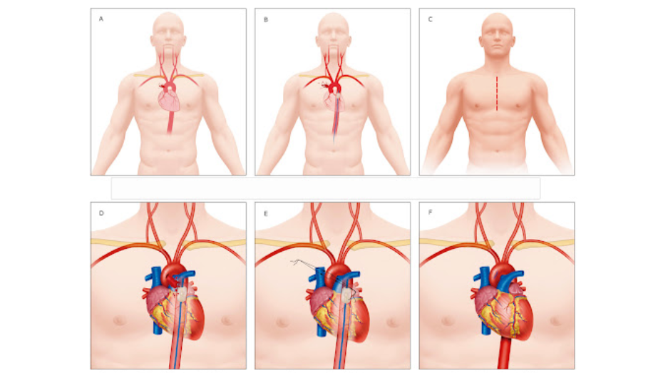 imagen prediseñada con tres cuerpos de hombre en la parte superior con incisión en medio del pecho y tres torsos abajo con corazón y arteria por donde va apareciendo progresivamente una línea azul