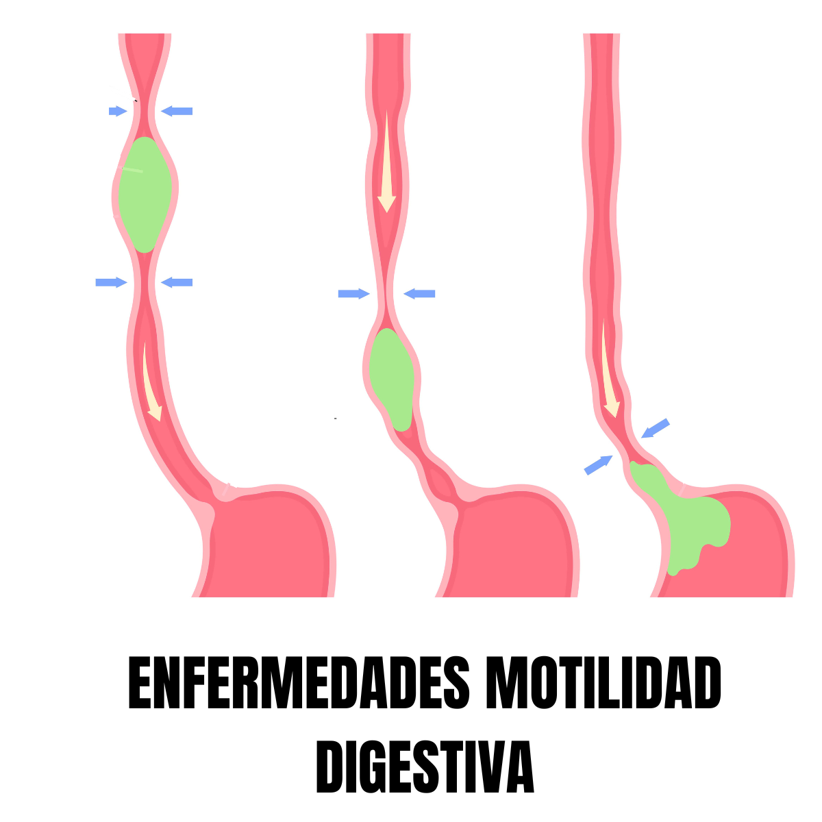 ilustración repetida de tramo esófago estrangulado por diversos sitios