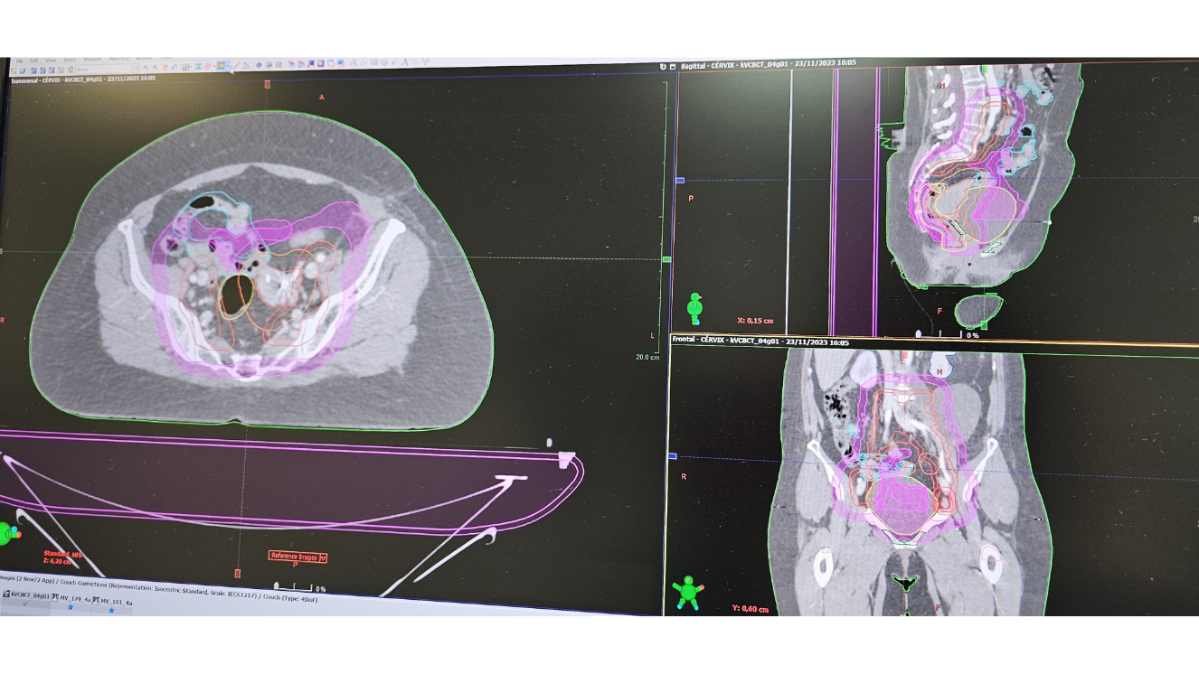 imagen de radioterapia