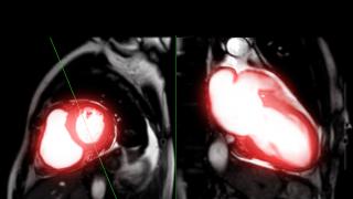 imagen escáner del corazón con la aorta iluminada de rojo
