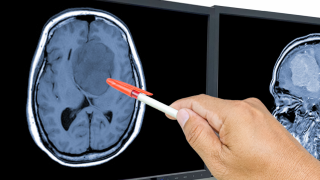 Imagen de un cerebro con glioblastoma y una mano que lo señala