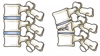 Fractura vertebral