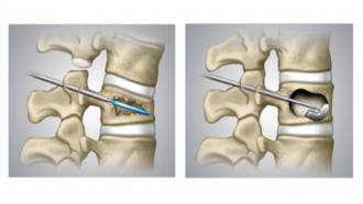 Vertebroplastia