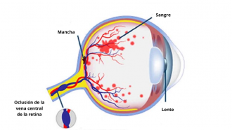 oclusión vena retina (prueba)