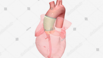 Ilustración de un corazón con parte de la aorta sustituido por un material