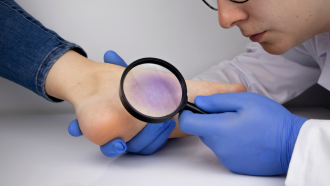 Anomalías vasculares médica mirando con lupa una mancha en pie