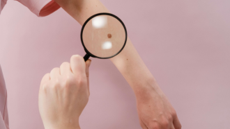 Tumoración cutánea brazo de niño con un lunar y mano con lupa que observa
