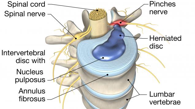 Hernia discal