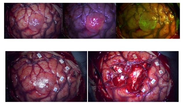 Tumor cerebral