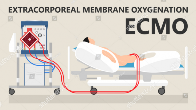 Ilustración de un soporte extracorporeal con cama de paciente al lado (prueba)