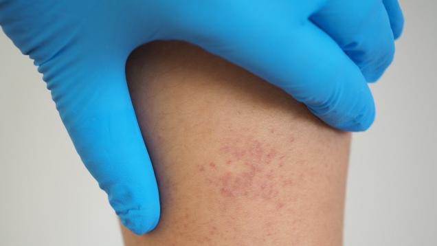 Mano con guante azul que señala manchitas rojas en una pierna