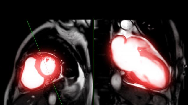 imagen escáner del corazón con la aorta iluminada de rojo