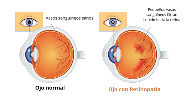 Imagen prediseñada de dos globos oculares uno con líneas rojas normales y otro con zonas rojas y sobre ellos dos ojos uno con el iris negro y el otro con una nube