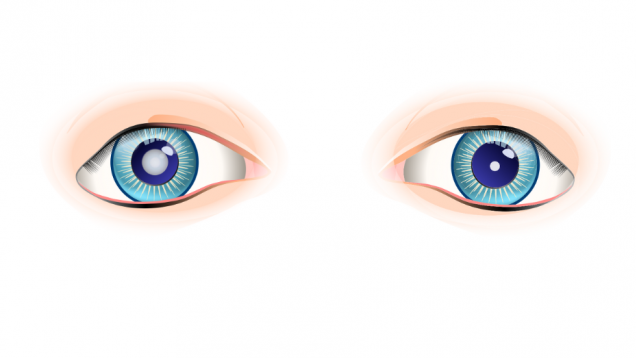 Imagen prediseñada de dos ojos uno sano y el otro con la pupila y el iris empañados por una nube