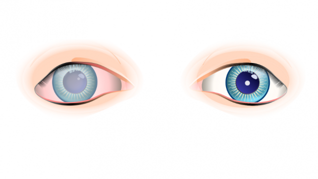 imagen prediseñada con ojo sano y ojo todo cubierto por una niebla