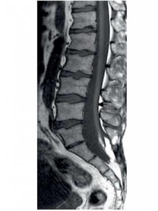 Médula anclada